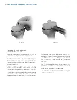 Preview for 66 page of Zimmer Biomet NexGen MIS LPS-Flex Surgical Technique Manual