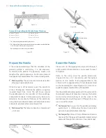 Preview for 30 page of Zimmer Biomet Persona Manual