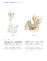 Preview for 4 page of Zimmer Biomet StageOn Series Surgical Technique