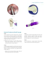 Предварительный просмотр 7 страницы Zimmer Biomet The AperFix Surgical Technique