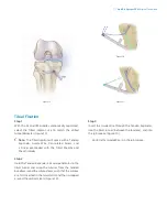 Предварительный просмотр 9 страницы Zimmer Biomet The AperFix Surgical Technique