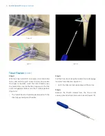 Предварительный просмотр 10 страницы Zimmer Biomet The AperFix Surgical Technique