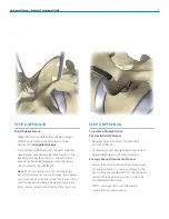 Preview for 7 page of Zimmer Biomet Universal Clamp Surgical Technique Manual