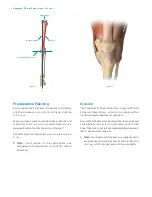 Preview for 6 page of Zimmer Biomet Vanguard  ID Total Knee Surgical Technique