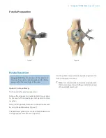 Preview for 7 page of Zimmer Biomet Vanguard  ID Total Knee Surgical Technique