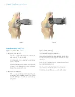 Preview for 8 page of Zimmer Biomet Vanguard  ID Total Knee Surgical Technique