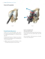 Preview for 10 page of Zimmer Biomet Vanguard  ID Total Knee Surgical Technique