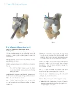 Preview for 12 page of Zimmer Biomet Vanguard  ID Total Knee Surgical Technique