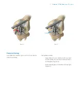 Preview for 13 page of Zimmer Biomet Vanguard  ID Total Knee Surgical Technique