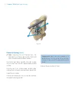 Preview for 14 page of Zimmer Biomet Vanguard  ID Total Knee Surgical Technique