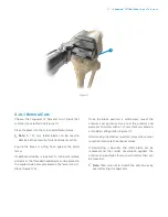 Preview for 15 page of Zimmer Biomet Vanguard  ID Total Knee Surgical Technique