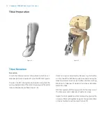 Preview for 16 page of Zimmer Biomet Vanguard  ID Total Knee Surgical Technique