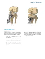 Preview for 17 page of Zimmer Biomet Vanguard  ID Total Knee Surgical Technique