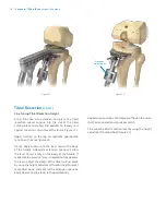 Preview for 18 page of Zimmer Biomet Vanguard  ID Total Knee Surgical Technique