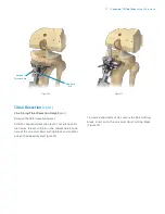 Preview for 19 page of Zimmer Biomet Vanguard  ID Total Knee Surgical Technique