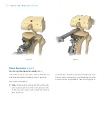 Preview for 20 page of Zimmer Biomet Vanguard  ID Total Knee Surgical Technique