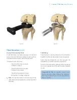 Preview for 21 page of Zimmer Biomet Vanguard  ID Total Knee Surgical Technique