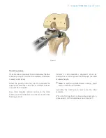 Preview for 23 page of Zimmer Biomet Vanguard  ID Total Knee Surgical Technique