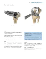 Preview for 25 page of Zimmer Biomet Vanguard  ID Total Knee Surgical Technique