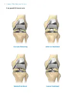 Preview for 28 page of Zimmer Biomet Vanguard  ID Total Knee Surgical Technique