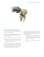 Preview for 31 page of Zimmer Biomet Vanguard  ID Total Knee Surgical Technique