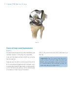 Preview for 32 page of Zimmer Biomet Vanguard  ID Total Knee Surgical Technique