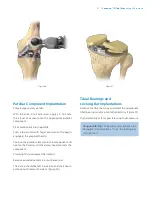 Preview for 33 page of Zimmer Biomet Vanguard  ID Total Knee Surgical Technique