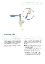 Preview for 7 page of Zimmer Biomet Zimmer Natural Nail Manual