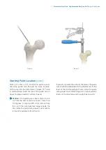 Preview for 9 page of Zimmer Biomet Zimmer Natural Nail Manual