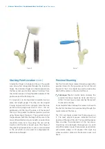 Preview for 10 page of Zimmer Biomet Zimmer Natural Nail Manual