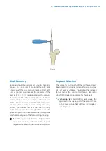 Preview for 11 page of Zimmer Biomet Zimmer Natural Nail Manual