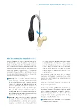 Preview for 13 page of Zimmer Biomet Zimmer Natural Nail Manual