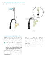 Preview for 14 page of Zimmer Biomet Zimmer Natural Nail Manual