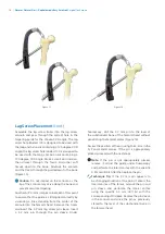 Preview for 16 page of Zimmer Biomet Zimmer Natural Nail Manual