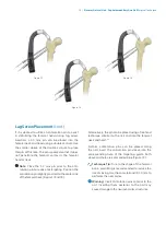 Preview for 17 page of Zimmer Biomet Zimmer Natural Nail Manual