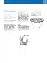 Предварительный просмотр 35 страницы Zimmer MIS Multi-Reference Surgical Technique