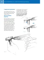 Предварительный просмотр 40 страницы Zimmer MIS Multi-Reference Surgical Technique