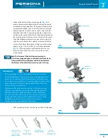 Предварительный просмотр 9 страницы Zimmer Persona Trabecular Metal Femoral Component Surgical Technique