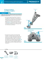 Предварительный просмотр 16 страницы Zimmer Persona Trabecular Metal Femoral Component Surgical Technique